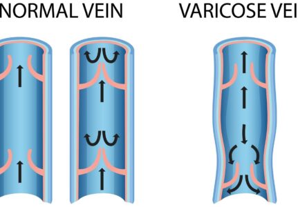 Cirurgia de Varizes em Sorocaba