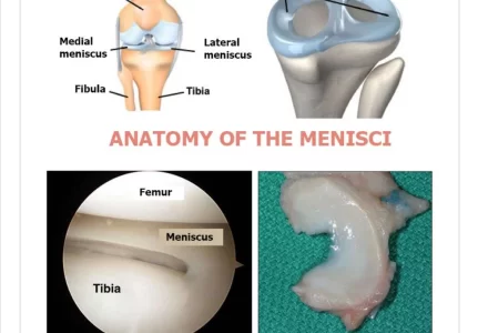Artroscopia do joelho menisco