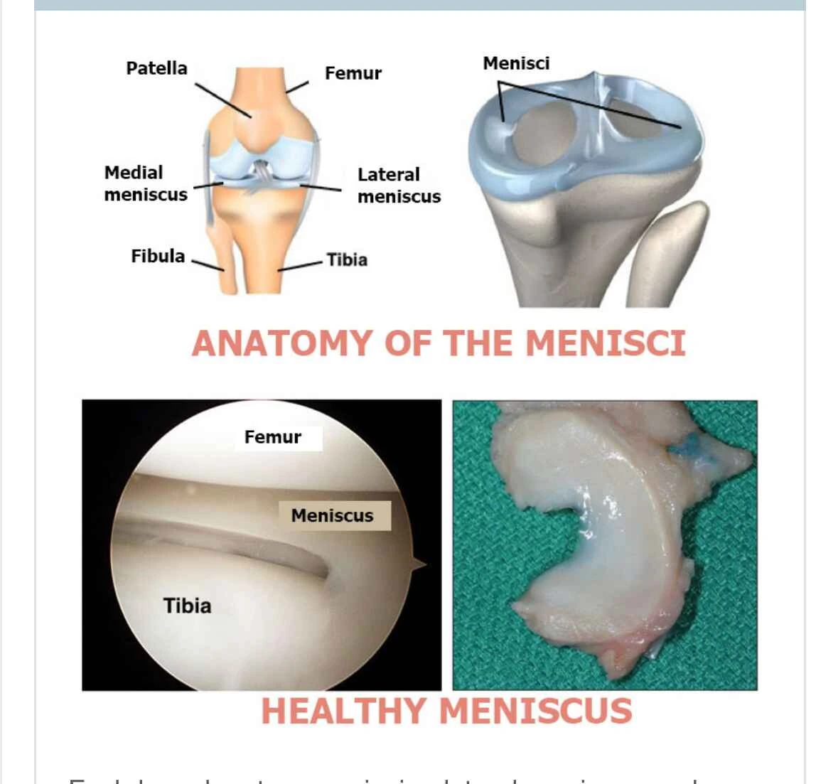 Artroscopia do joelho menisco
