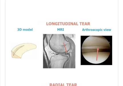 Artroscopia do joelho valor