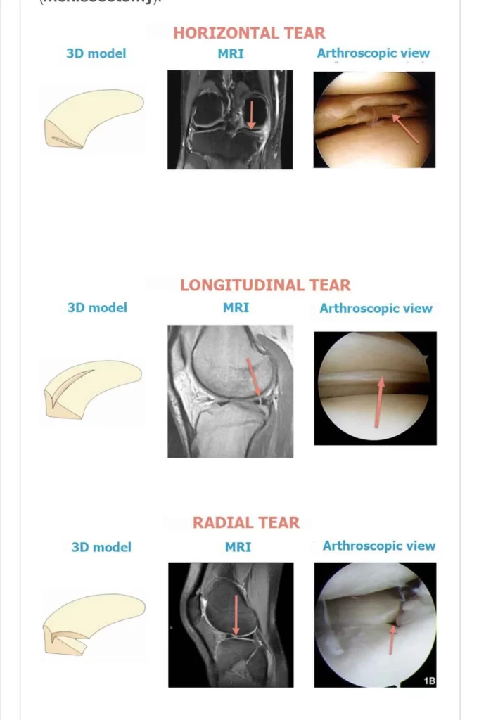 Artroscopia do joelho valor
