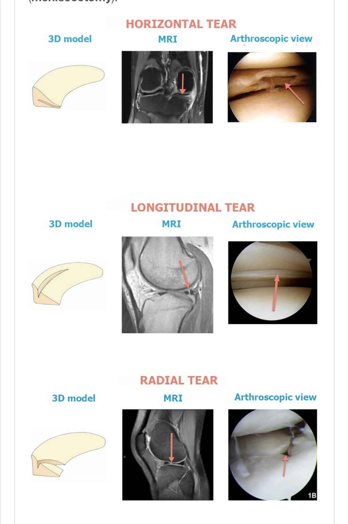 Artroscopia do joelho valor
