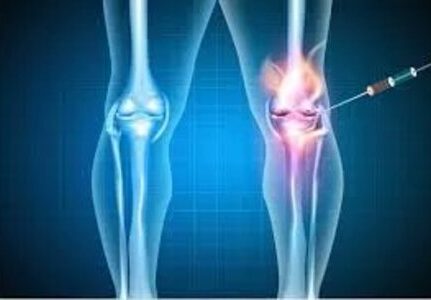 Médico especialista em infiltração nos joelhos