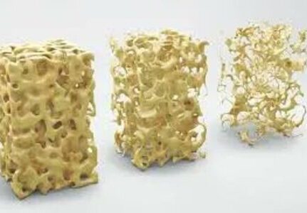 O melhor reumatologista para tratamento de osteoporose