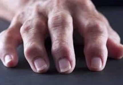 Reumatologista que trata osteoartrite