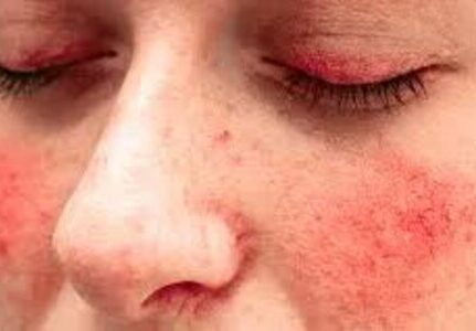 O melhor reumatologista para lúpus