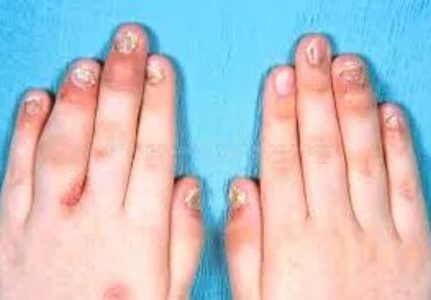 Reumatologista que trata artrite psoriásica