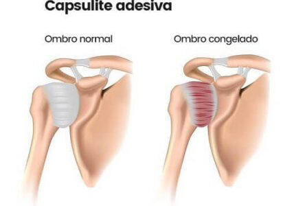 Capsulite adesiva de ombro