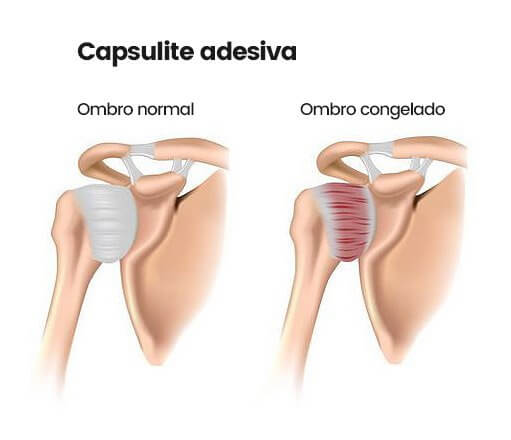 Capsulite adesiva de ombro