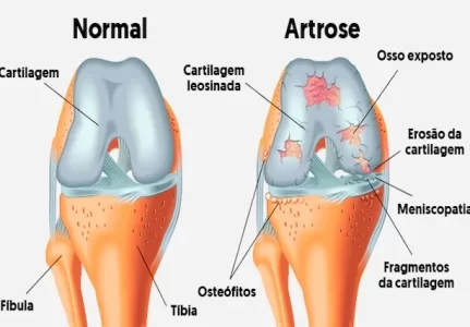 Tratamento para artrose