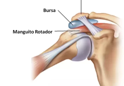 Tratamento para bursite no ombro