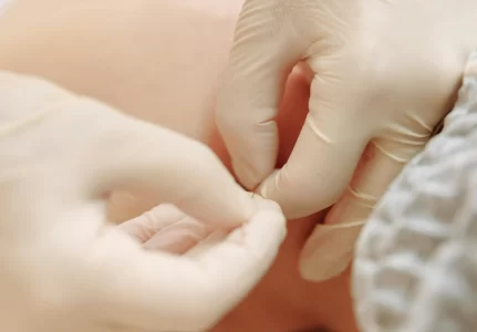 Como Funciona a Acupuntura?