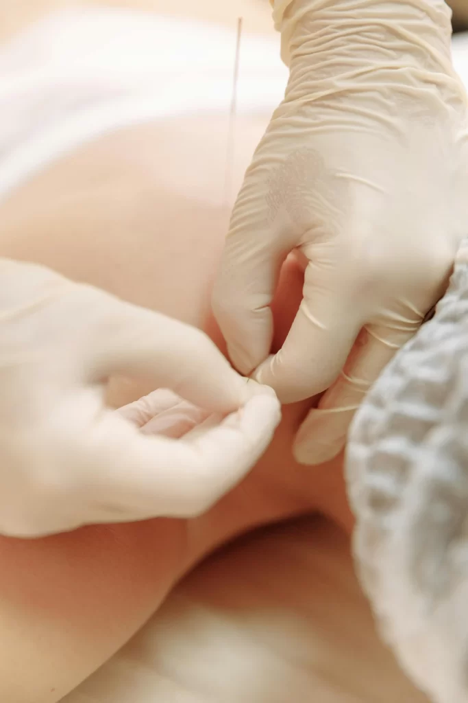 Como Funciona a Acupuntura?