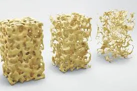 O melhor Reumatologista para tratamento de osteoporose