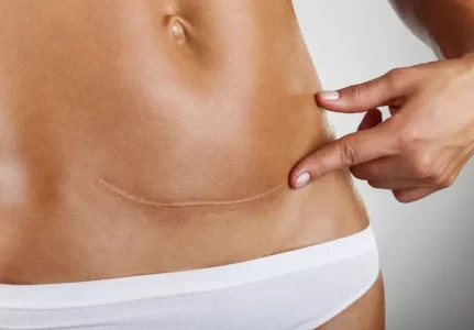 Tratamento a Laser para Cicatriz Preço