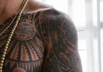 Tratamentos com Acupuntura em Guarulhos