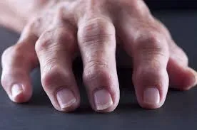 Reumatologista que trata Osteoartrite
